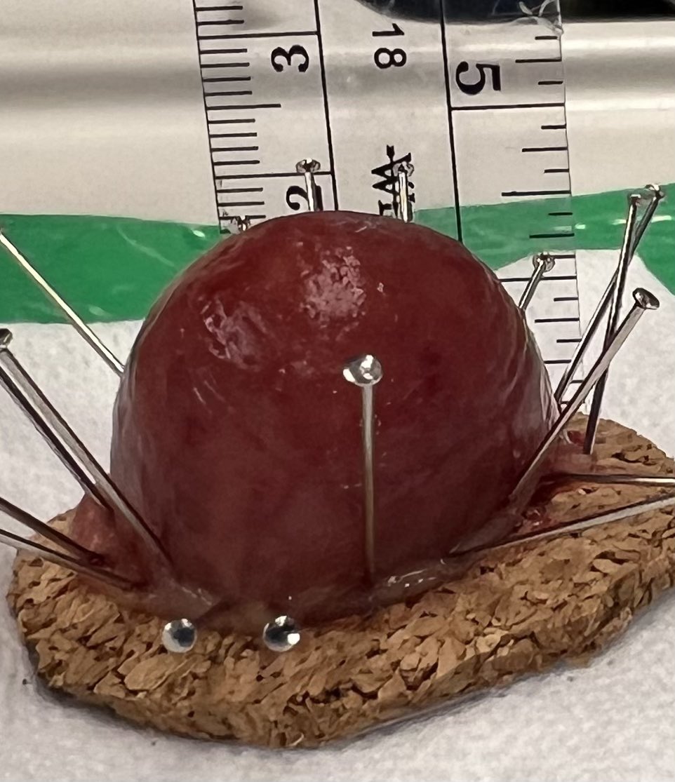 EUSandEndoscopy's tweet photo. Large colonic #lipoma with interval growth & patient desired removal with confirmation pathologically benign. #EndoscopicallyResected with #endoloop followed by snare cautery #polypectomy. See @EndoscopyOthman video as well https://t.co/os96Ff6BWc https://t.co/ObEAeSPg6W