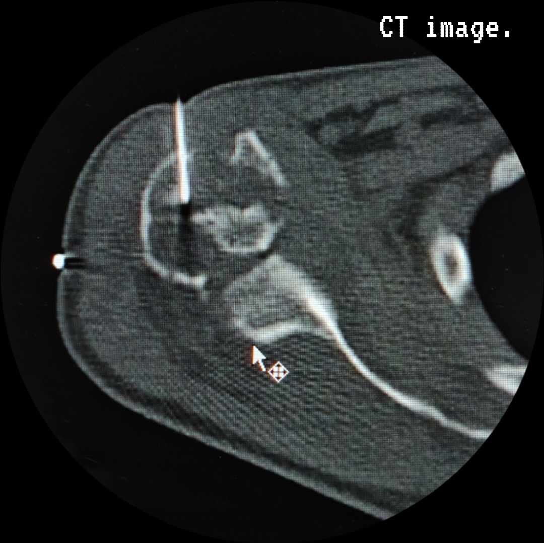 SyedSal55391459's tweet photo. #CTguidedFNAC
#microphotography
#lytic lesion of rt. humeral head.
CT image.
H&E smear.
ZN smear.
Dx: Tuberculosis.
(Plenty of AFB in ZN smear) https://t.co/2A1M6R2iBa