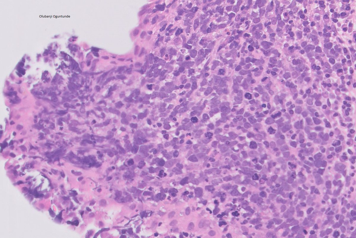 bjbanji's tweet photo. Bronchial biopsy.
Micro- small cells (not so small though!) with molding, nuclear streaks and loads of mitosis/apoptosis.
CD45(-),CD56(+),TTF-1(+),Chromo(+),Synap(+) MNF116(-),CK8/18 (very focally +ve)
✔️Small cell neuroendocrine carcinoma
#GeneralPathology #PulmonaryPathology https://t.co/d7YoOewvQx