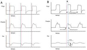 Trigger reverso durante ventilación mecánica: diagnóstico e implicaciones clínicas. medintensiva.org/es-trigger-rev…