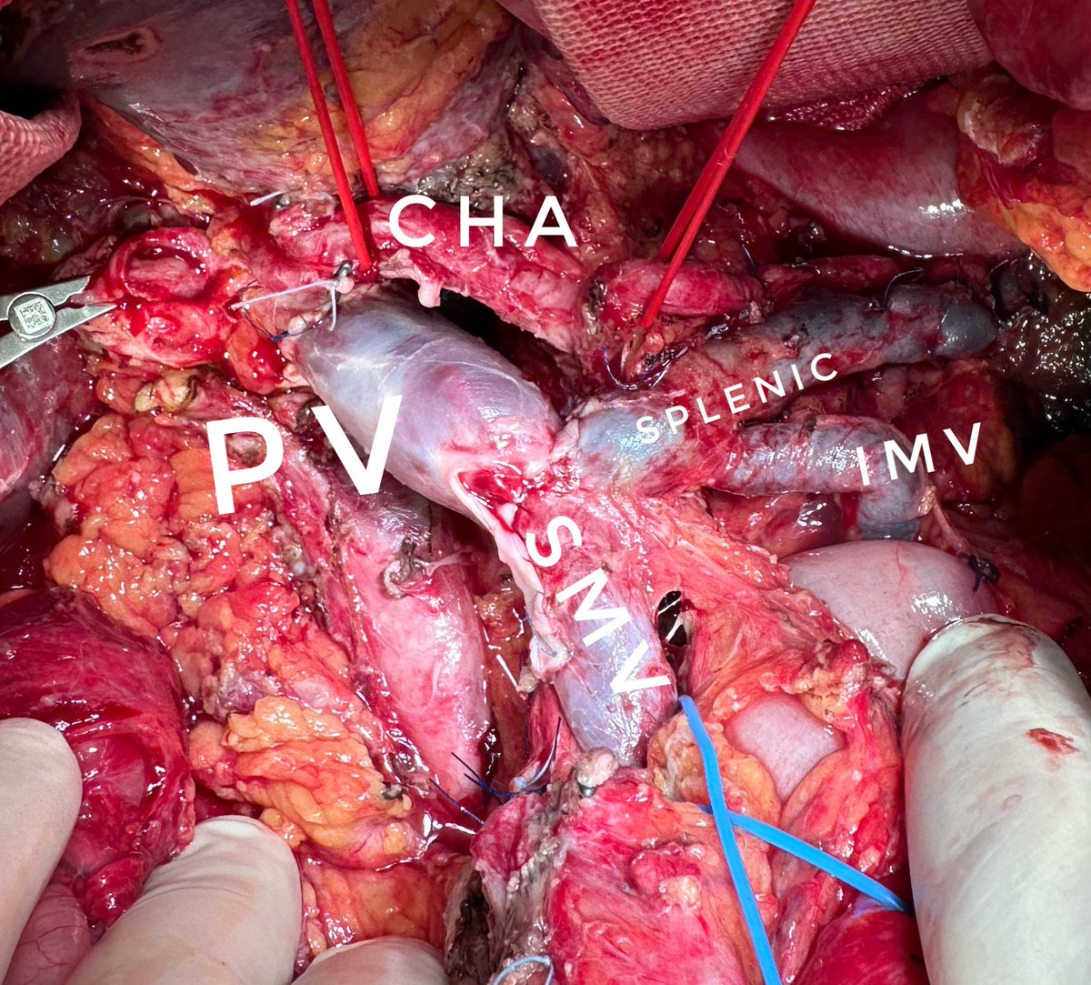 Pancreas surgery meets 🤝 Transplant surgery when it comes to vascular resections in PDAC 

🚨 LAPC involving CHA and PV

💉 Folfirinox x12 radiological / biological response + fit for surgery 

🌽 CHA divestment 
🧞‍♂️ PV resected + 10 cm graft allogenic cadaveric vein