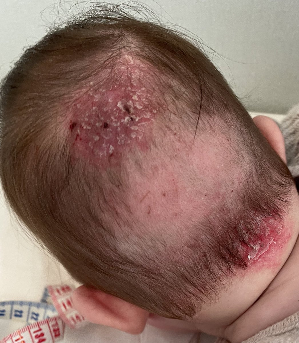 #DocTocToc F3M, quelques lésions d’eczéma sur le corps, présente cette lésion du scalp. DCTC inefficaces… 
Qu’en diriez-vous ? 
Non suintant, je teste atb local puis vaseline
