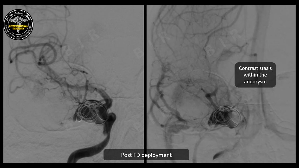 Interventional Radiology BIR, RGGGH@Chennai (@iradbir_chennai) on Twitter photo #Flow_diverter assisted #coiling for a case of dissecting ICA #aneurysm in 17M with ptosis.
#iRad #MedTwitter
<a href="/ISVIRIndia/">ISVIR India</a> <a href="/PouriaMoshayedi/">Pouria Moshayedi, MD PhD</a> <a href="/daigaole/">Dr. Dai</a> <a href="/Mjoshiindia/">Manisha Joshi</a> <a href="/hari_the_IR/">Hariharaprakash Radhakrishnan</a> <a href="/vimalchackomdy/">Vimal Chacko MD DNB DM EBIR</a> <a href="/GuenegoAdrien/">The French Brain Doctor</a> <a href="/drgauravgangwni/">Dr. Gaurav Gangwani (Interventional Radiologist)</a> <a href="/karananandpara/">Karan Anandpara</a> <a href="/zafarhashim_INR/">Zafar Hashim</a> <a href="/SharathKumarGG7/">Dr Sharath Kumar G</a> #Flow_diverter assisted #coiling for a case of dissecting ICA #aneurysm in 17M with ptosis.
#iRad #MedTwitter
<a href="/ISVIRIndia/">ISVIR India</a> <a href="/PouriaMoshayedi/">Pouria Moshayedi, MD PhD</a> <a href="/daigaole/">Dr. Dai</a> <a href="/Mjoshiindia/">Manisha Joshi</a> <a href="/hari_the_IR/">Hariharaprakash Radhakrishnan</a> <a href="/vimalchackomdy/">Vimal Chacko MD DNB DM EBIR</a> <a href="/GuenegoAdrien/">The French Brain Doctor</a> <a href="/drgauravgangwni/">Dr. Gaurav Gangwani (Interventional Radiologist)</a> <a href="/karananandpara/">Karan Anandpara</a> <a href="/zafarhashim_INR/">Zafar Hashim</a> <a href="/SharathKumarGG7/">Dr Sharath Kumar G</a>