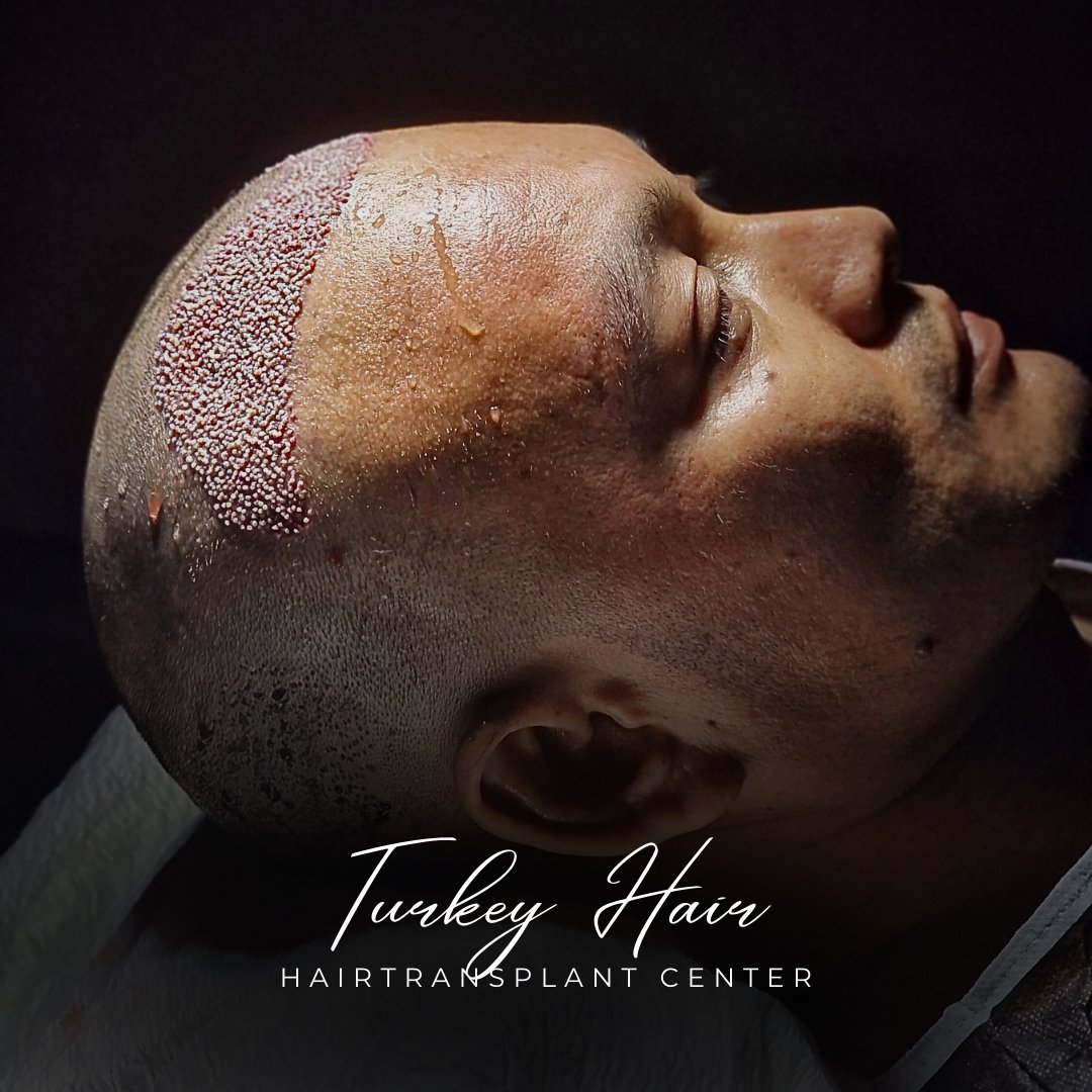 TurkeyHairCentr's tweet photo. HAPPY PATIENT WITH  HAIR TRANSPLANT TURKEY  ✨💯 

Book your appointment today and take the first step towards a new you!  
✨https://t.co/qAvHmxezMn……   

💻https://t.co/M0SJqrJQRK 

📧turkeyhairgroup@gmail.com
Peso Pluma | #PalestinianGenocide | Biden | Macklemore | Zendaya | Durk | Killers of the Flower Moon