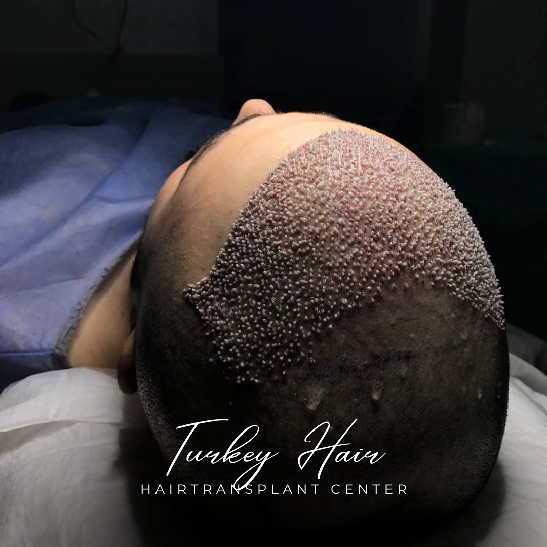 TurkeyHairCentr's tweet photo. HAPPY PATIENT WITH  HAIR TRANSPLANT TURKEY  ✨💯 

Book your appointment today and take the first step towards a new you!  
✨https://t.co/qAvHmxezMn……   

💻https://t.co/M0SJqrJQRK 

📧turkeyhairgroup@gmail.com
Peso Pluma | #PalestinianGenocide | Biden | Macklemore | Zendaya | Durk | Killers of the Flower Moon