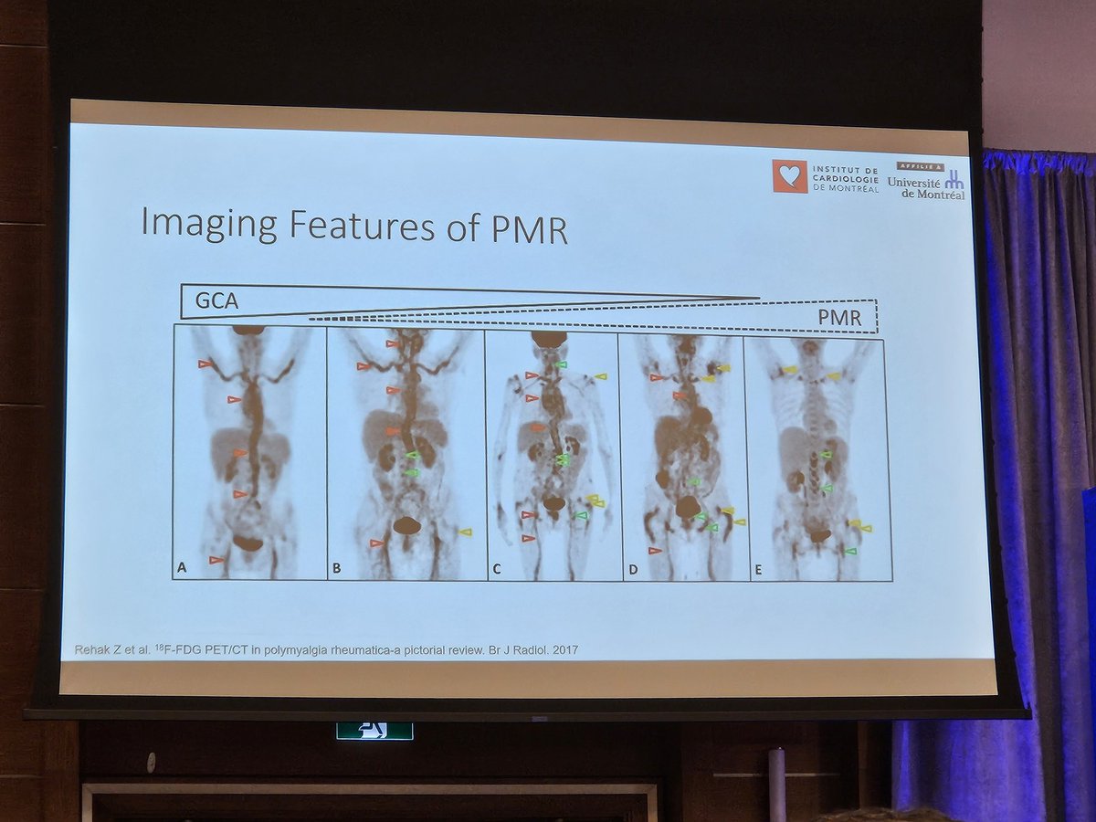 Brilliant talk by Dr. Matthieu Pelletier Gallarneau about vasculitis, its different forms and pitfalls in reading the scans. After 3 days of steroids, FDG PET is no longer useful! #CANM @ONucmed