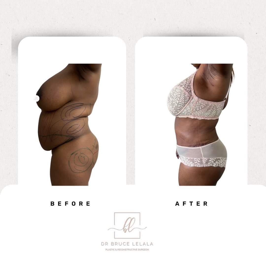 #Abdominoplasty (#TummyTuck)

Why it's done:
There are a number of reasons u might have excess fat, poor elasticity of the skin or weakened connective tissue in your abdomen. 

These include:
- Significant changes in weight
- #Pregnancy
- #Abdominalsurgery, such as a - C-section