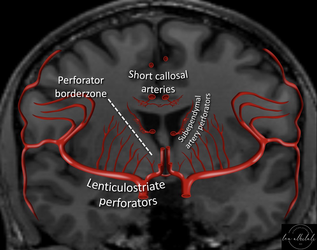 teachplaygrub's tweet photo. They say good things come in small packages--well important things are supplied by small arteries!

Everyone knows large vessel anatomy--but do you know perforator anatomy?

Basal ganglia is fed by perforators &amp; the borderzone territory is the internal capsule—small but key! https://t.co/l5akLmxbS9