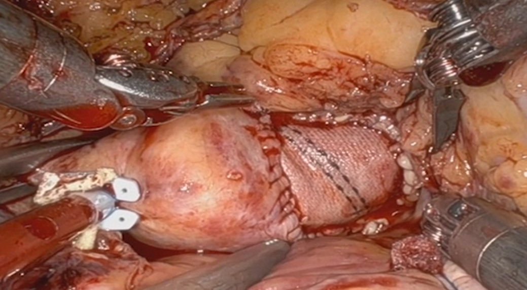 adarehzereshki's tweet photo. In Press: Feasibility and safety of robotic aortic root enlargement in conjunction with robotic aortic valve replacement
https://t.co/uQOuskDpkH
#robotic_cardiac_surgery
#RAVR
#aortic_root_enlargement https://t.co/tBuqrJj4d1