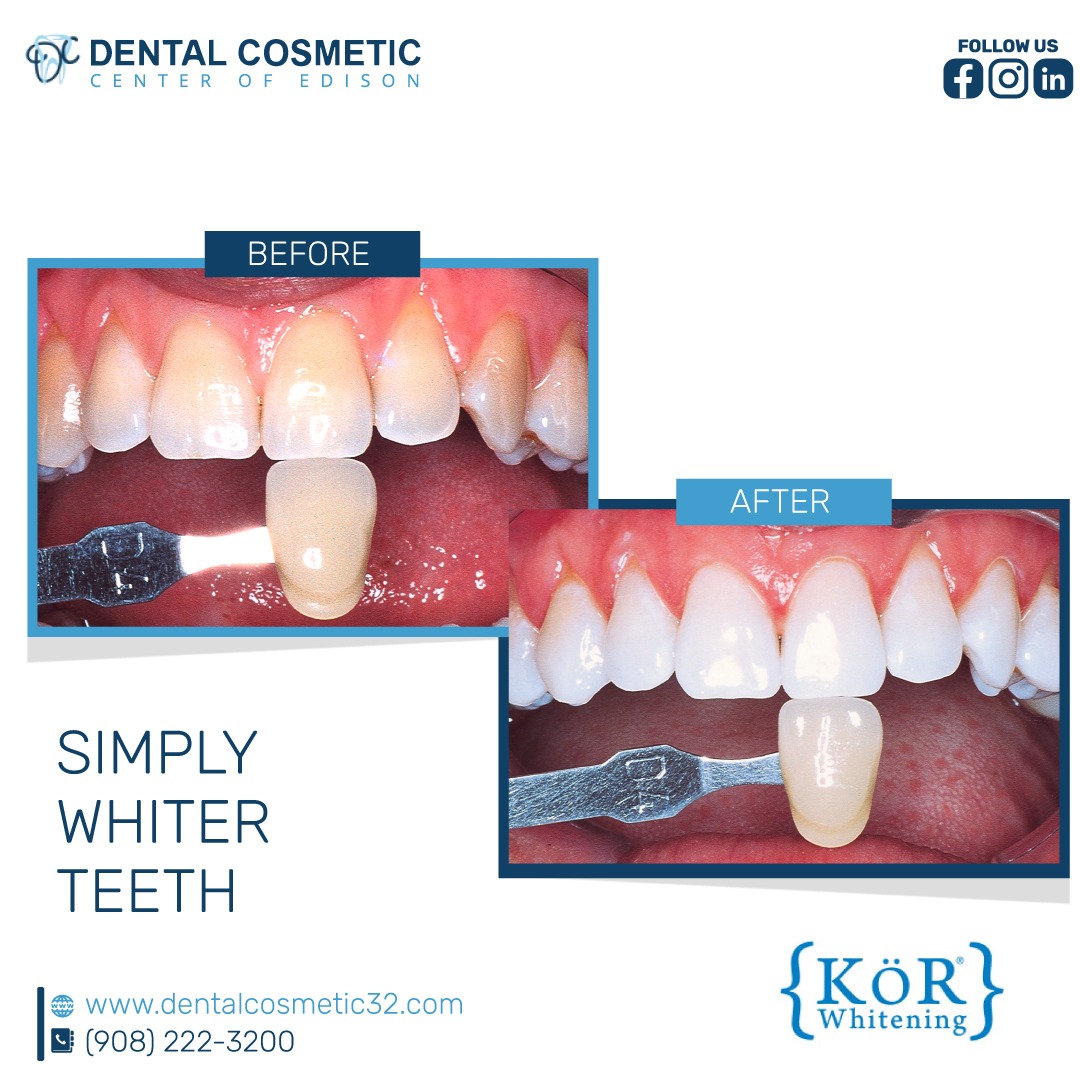 Don't just dream of a whiter smile; make it a reality with our dental expertise !!

#DentalCosmeticMagic #TeethWhiteningMagic #SmileTransformation #BeforeAndAfter #WhiteTeethConfidence #SmileBrighter #SmileConfidence #DentalImplants #NaturalTeeth #SmileRenewal #FunctionalBeauty