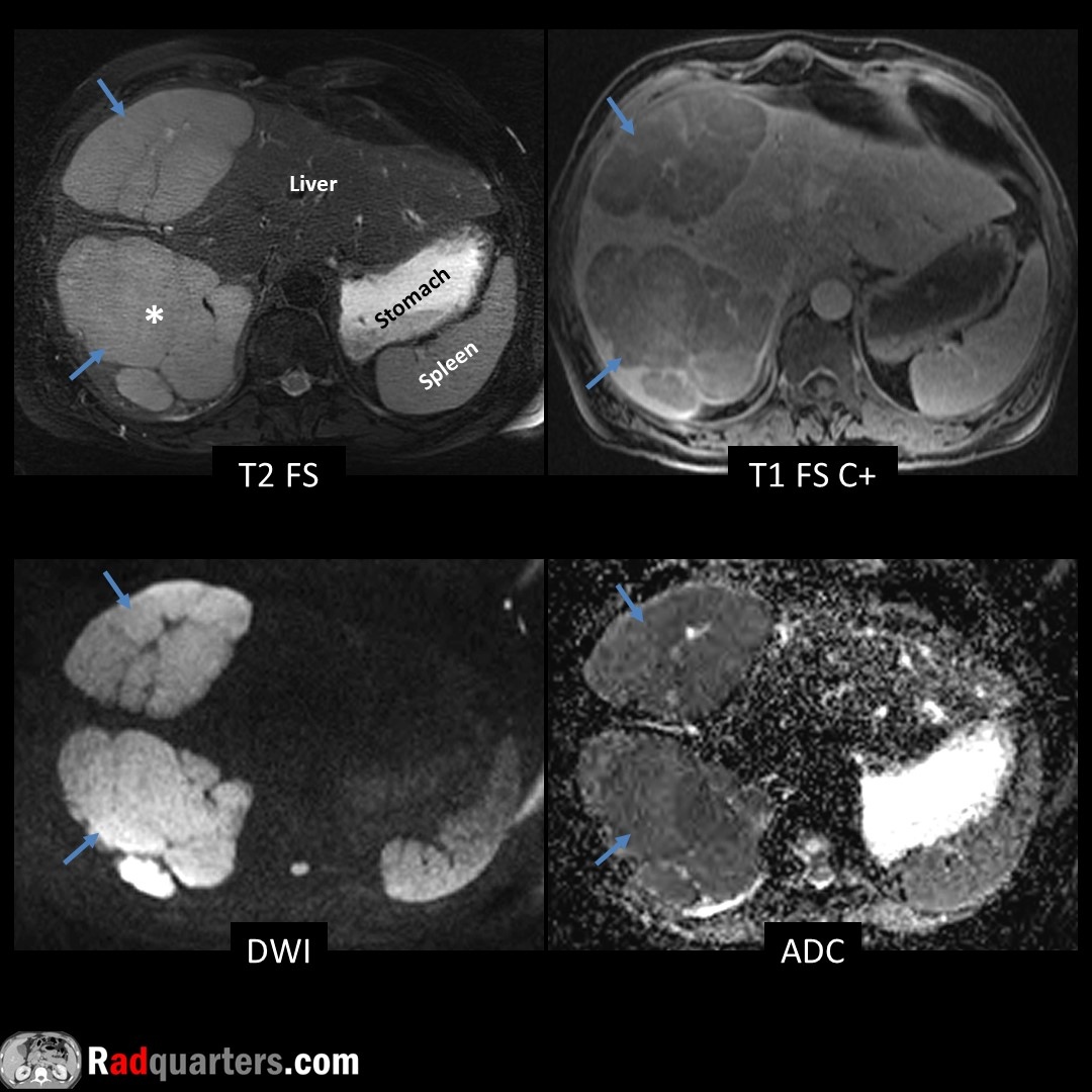 Multifocal primary hepatic lymphoma. Rare. Often solitary unlike diffusely infiltrating secondary lymphoma. T1 dark, T2 bright (relative to liver), hypoenhancing w/ faint rim enhancement. Marked restricted diffusion due to hypercellularity. Path = High-grade B-cell. #FOAMrad