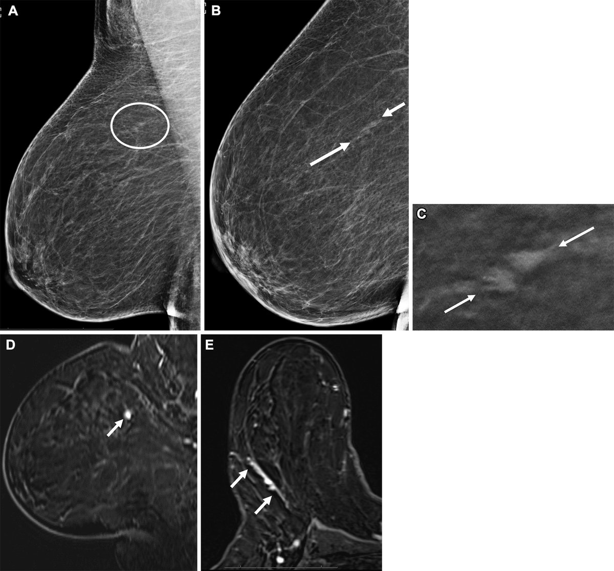 RadioGraphics (@radiographics) on Twitter photo With high sensitivity and negative predictive value, breast MRI is well suited to problem solving when other means are equivocal for breast cancer. <a href="/NYUImaging/">NYU Langone Health Department of Radiology</a>
<a href="/bea_reig/">Bea Reig, MD</a> <a href="/EricKimMD/">Eric Kim</a> <a href="/heacockmd/">Laura Heacock, MD</a> <a href="/DrLindaMoy/">Linda Moy</a> bit.ly/40drPsB With high sensitivity and negative predictive value, breast MRI is well suited to problem solving when other means are equivocal for breast cancer. <a href="/NYUImaging/">NYU Langone Health Department of Radiology</a>
<a href="/bea_reig/">Bea Reig, MD</a> <a href="/EricKimMD/">Eric Kim</a> <a href="/heacockmd/">Laura Heacock, MD</a> <a href="/DrLindaMoy/">Linda Moy</a> bit.ly/40drPsB