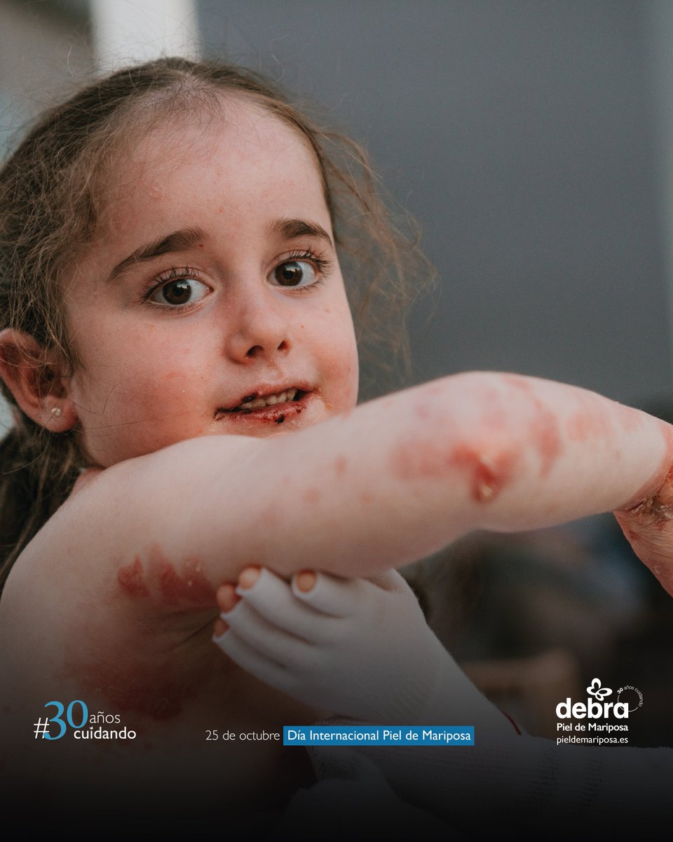 🦋 Ella es Mía. Un abrazo puede causarle heridas.

❤️‍🩹 Cada acción de la vida cotidiana, como caminar y comer, puede desencadenar consecuencias dolorosas. Puede provocarle heridas, ampollas, el desprendimiento de la piel y muchísimo dolor.

#EBAwareness #PielDeMariposa