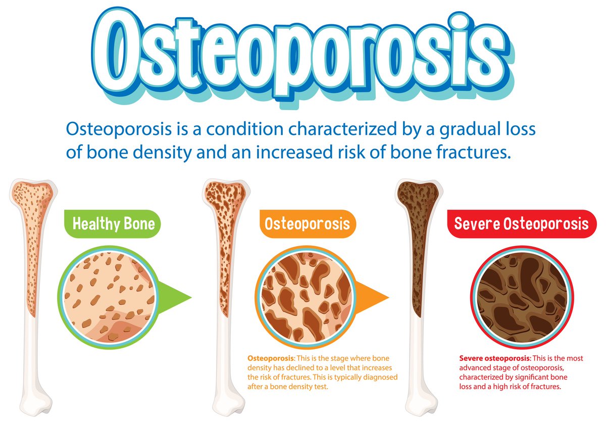 sdch_official's tweet photo. 𝗪𝗢𝗥𝗟𝗗 𝗢𝗦𝗧𝗘𝗢𝗣𝗢𝗥𝗢𝗦𝗜𝗦 𝗗𝗔𝗬

World Osteoporosis Day is observed annually on the 20th of October, and launches a year-long campaign dedicated to raising global awareness of the prevention, diagnosis and treatment of osteoporosis and metabolic bone disease. https://t.co/WxQh9ko8CW