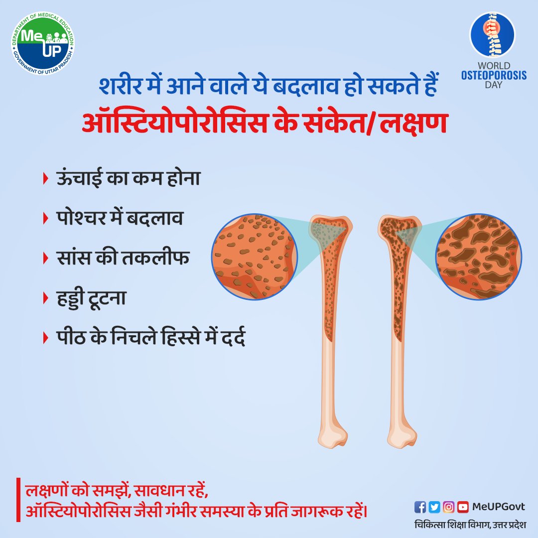 #WorldOsteoporosisDay
ऑस्टियोपोरोसिस  एक ऐसी बीमारी है जहां कैल्शियम की कमी के कारण हड्डियां कमजोर हो जाती हैं और फ्रैक्चर होने का खतरा होता है। इससे शरीर के विभिन्न हिस्सों जैसे कमर, गर्दन और घुटनों में दर्द हो सकता है। यह बीमारी अब युवा व्यक्तियों, विशेषकर महिलाओं को अधिक