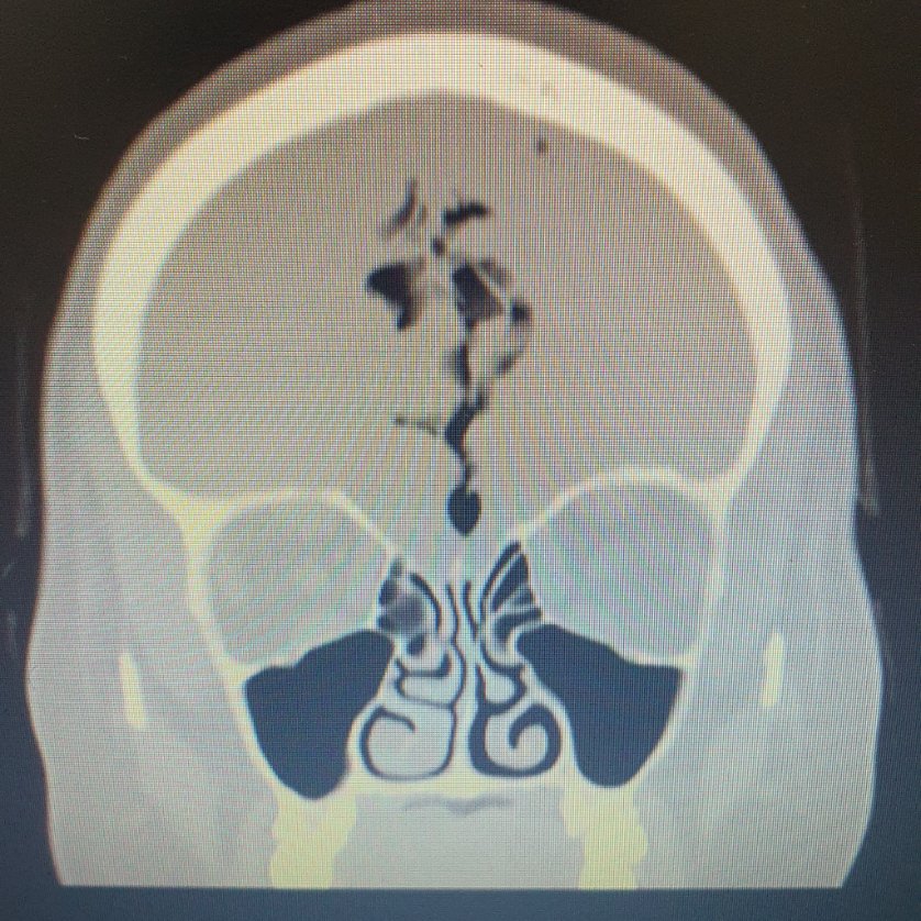 ISumaily's tweet photo. العطسة التي قصمت قاع الدماغ!

من مخاطر منع خروج العطاس:
- ثقب قاع الجمجمة، ونتيجة لذلك يحصل تسرب سائل الدماغ والتهاب السحايا، وما قد ينجم عنه من مضاعفات قد تصل للوفاة لا قدر الله.
- ثقب طبلة الأذن.
- ثقب النافذة الدائرة للأذن الداخلية، وينجم عنه دوار شديد وفقد دائم للسمع. https://t.co/JIPDa8sblP