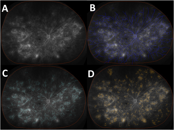 Granular longitudinal trends in quantitative ultrawide-field fluorescein angiography features such as leakage index and phenotype, ischemic index, and microaneurysm count in diabetic retinopathy without macular edema <a href="/gagankalra_md/">Gagan Kalra, MD</a> <a href="/ClevelandClinic/">Cleveland Clinic</a> ow.ly/FMLY50PLB7q