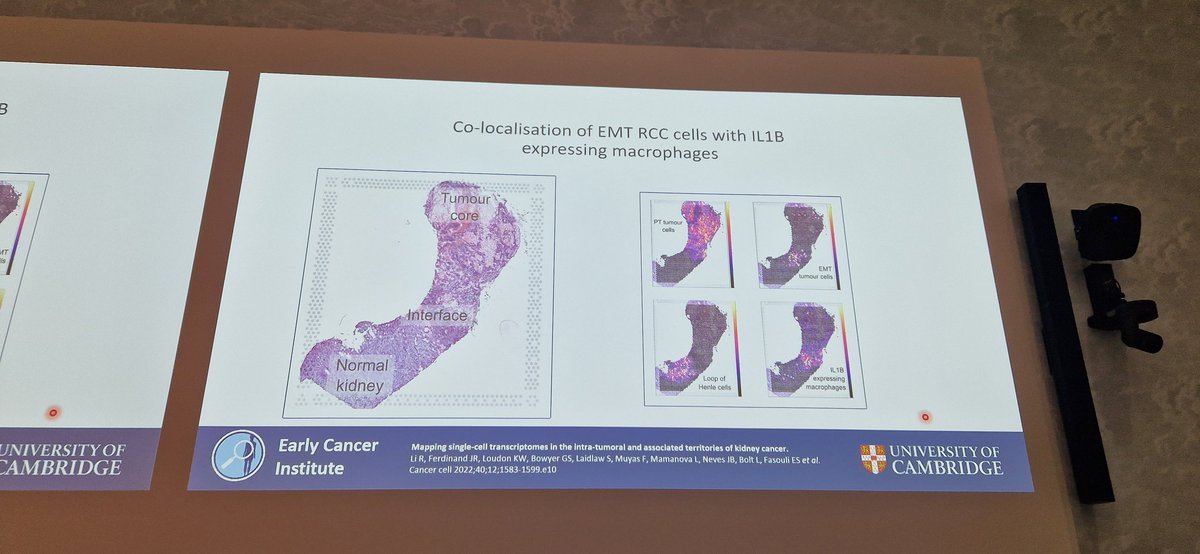 LambAlastair's tweet image. Has @Tom_J_Mitchell finally come round to #SpatialTranscriptomics?! Lovely talk & scope of work presented at #ESUR23 from his @EarlyCancerCam group
Using ST to define transition from benign to malignant #KidneyCancer & oppo for early detection/intervention
@ChloePacyna @Uroweb