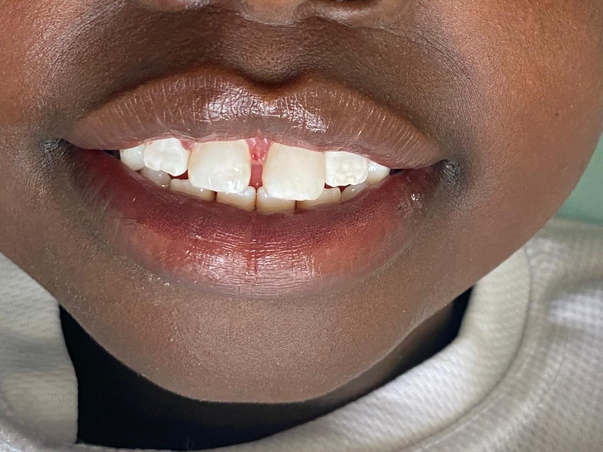 dentistry_house's tweet photo. Good news! An amazing 🧧 reward's calling! This challenge is for our shujaaz 💪- those who've been following our updates keenly. What treatment did we offer this young champ? The top 2 replies enter a draw during this Mashujaa Weekend for a quick airtime gift worth KES. 500. All the best! 👏 #WeSmileWithYou