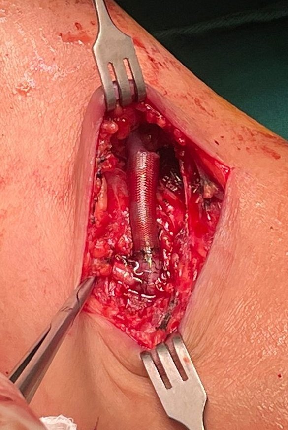 Implanted my first #VasQ device today! Early results look promising! Hoping it will benefit our dialysis patients! #dialysisaccess #vascularsurgery #vascular #nephrology #dialysis #laminate