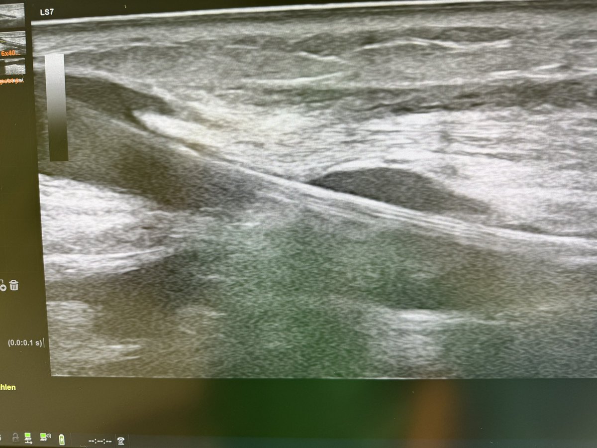 robshahverdyan's tweet photo. We all basically know we need good vessel preparation prior to DCB in #AVF. But do we need to perform a #POBA prior to #DCB, if we use a hpDCB? 🤷🏻♂️. High grade JAS perf in #endoAVF #pAVF, treated by 6mm Aperto hpDCB 20ATM only - with beautiful result. Longer term to be evaluated https://t.co/EdiYZkxwRe
