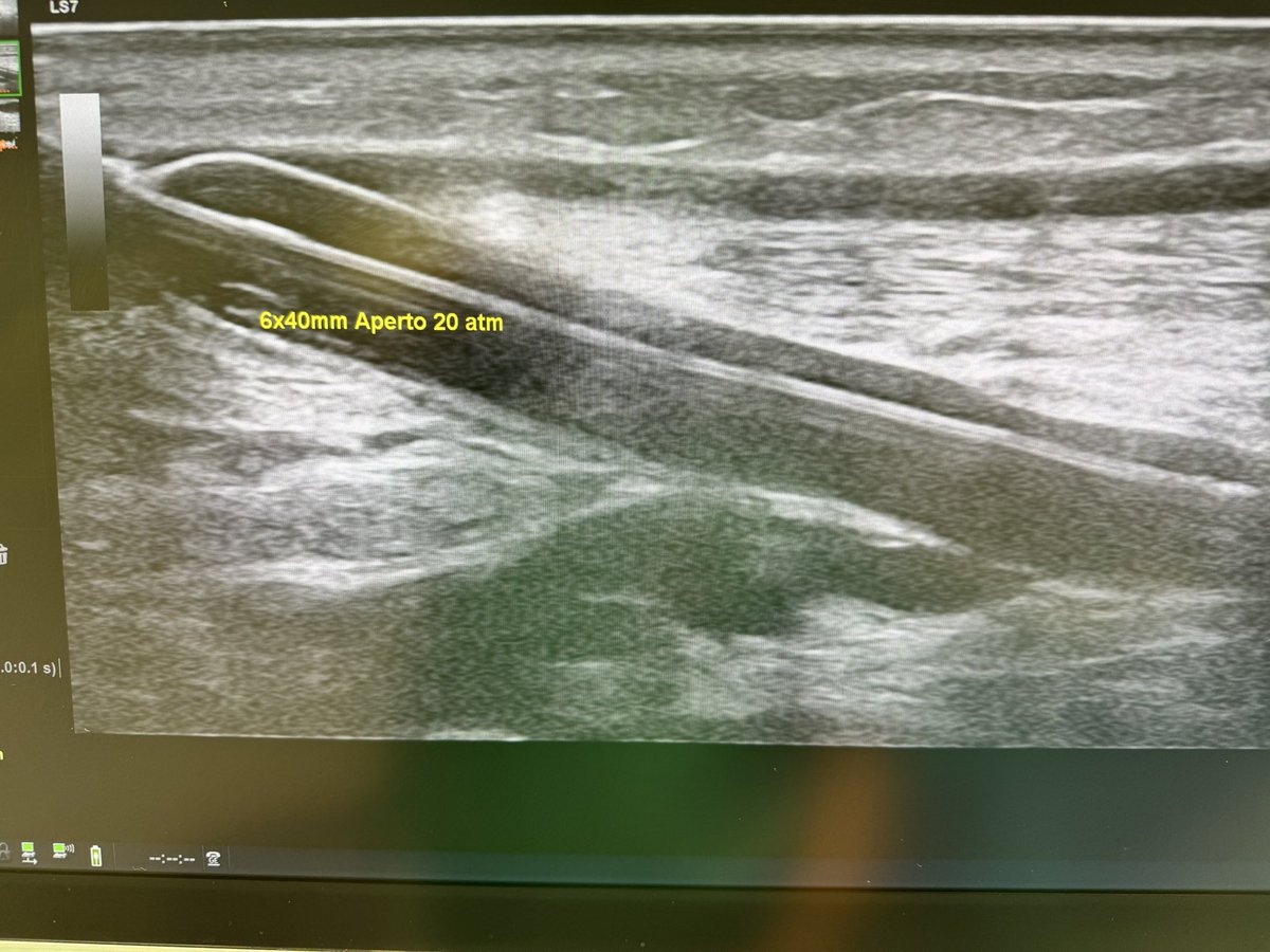 robshahverdyan's tweet photo. We all basically know we need good vessel preparation prior to DCB in #AVF. But do we need to perform a #POBA prior to #DCB, if we use a hpDCB? 🤷🏻♂️. High grade JAS perf in #endoAVF #pAVF, treated by 6mm Aperto hpDCB 20ATM only - with beautiful result. Longer term to be evaluated https://t.co/EdiYZkxwRe