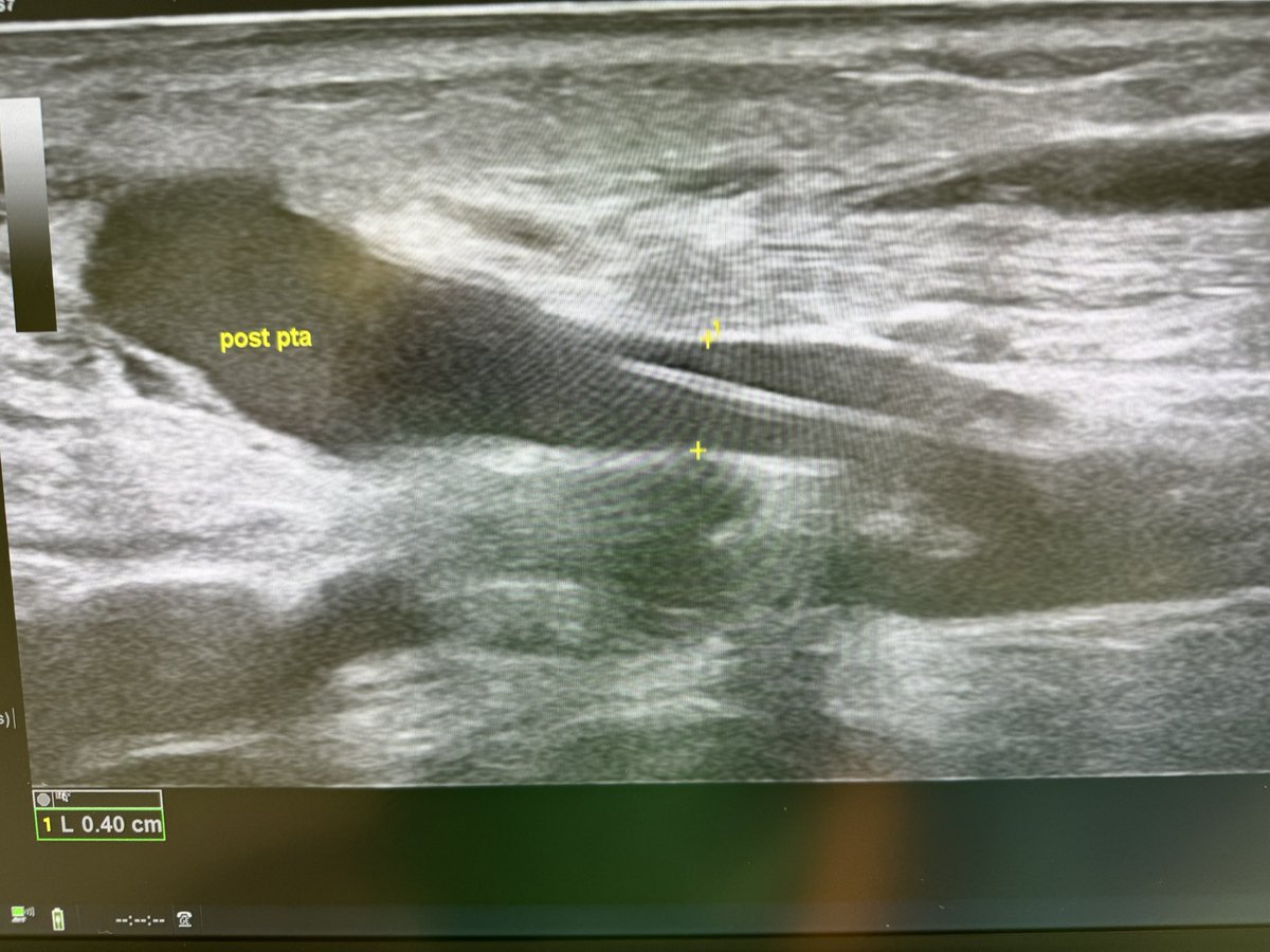 robshahverdyan's tweet photo. We all basically know we need good vessel preparation prior to DCB in #AVF. But do we need to perform a #POBA prior to #DCB, if we use a hpDCB? 🤷🏻♂️. High grade JAS perf in #endoAVF #pAVF, treated by 6mm Aperto hpDCB 20ATM only - with beautiful result. Longer term to be evaluated https://t.co/EdiYZkxwRe