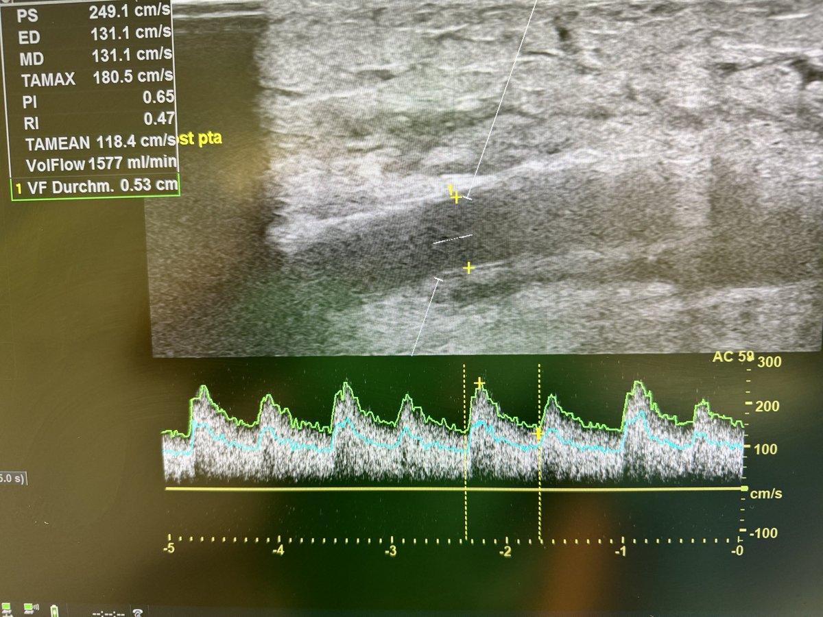 robshahverdyan's tweet photo. We all basically know we need good vessel preparation prior to DCB in #AVF. But do we need to perform a #POBA prior to #DCB, if we use a hpDCB? 🤷🏻♂️. High grade JAS perf in #endoAVF #pAVF, treated by 6mm Aperto hpDCB 20ATM only - with beautiful result. Longer term to be evaluated https://t.co/EdiYZkxwRe
