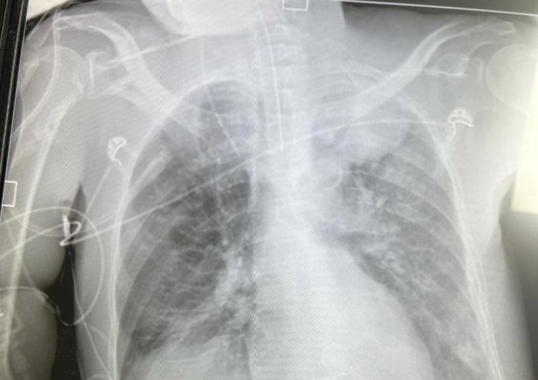 If you ever wondered why chest physiotherapy in ITU just look at this my patient- a complete left lung collapse before and after chest physiotherapy CXR