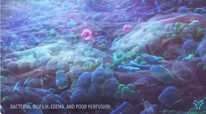 OmezaSkin's tweet photo. A veneer of harmful microbes known as biofilm often forms over chronic wounds and significantly delays healing. Omeza® Collagen Matrix reduces bacteria responsible for biofilm impact, thereby speeding chronic wound healing. Learn more about OCM™ at https://t.co/nU7yFllLtj https://t.co/autv4nn5aL