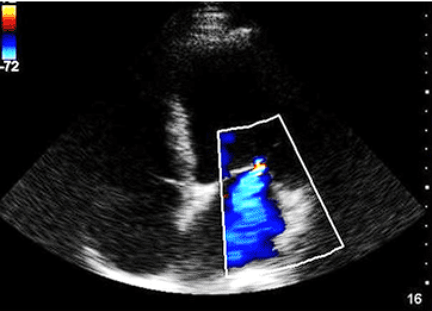 Want to learn about diagnosing and managing acute mitral regurgitation in the ED? 

Check out our blog post by Dr. Aubuchon (PGY-3) and Dr. Barskaya (ED-Critical Care physician) that dives into the clinical approach from a case perspective! #EM #FOAMEd 

🔗nyp-cc.com/dart/acutemrap…