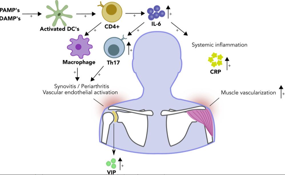 What Goes Wrong with the Immune System in #PMR? bit.ly/3Fpjvw1