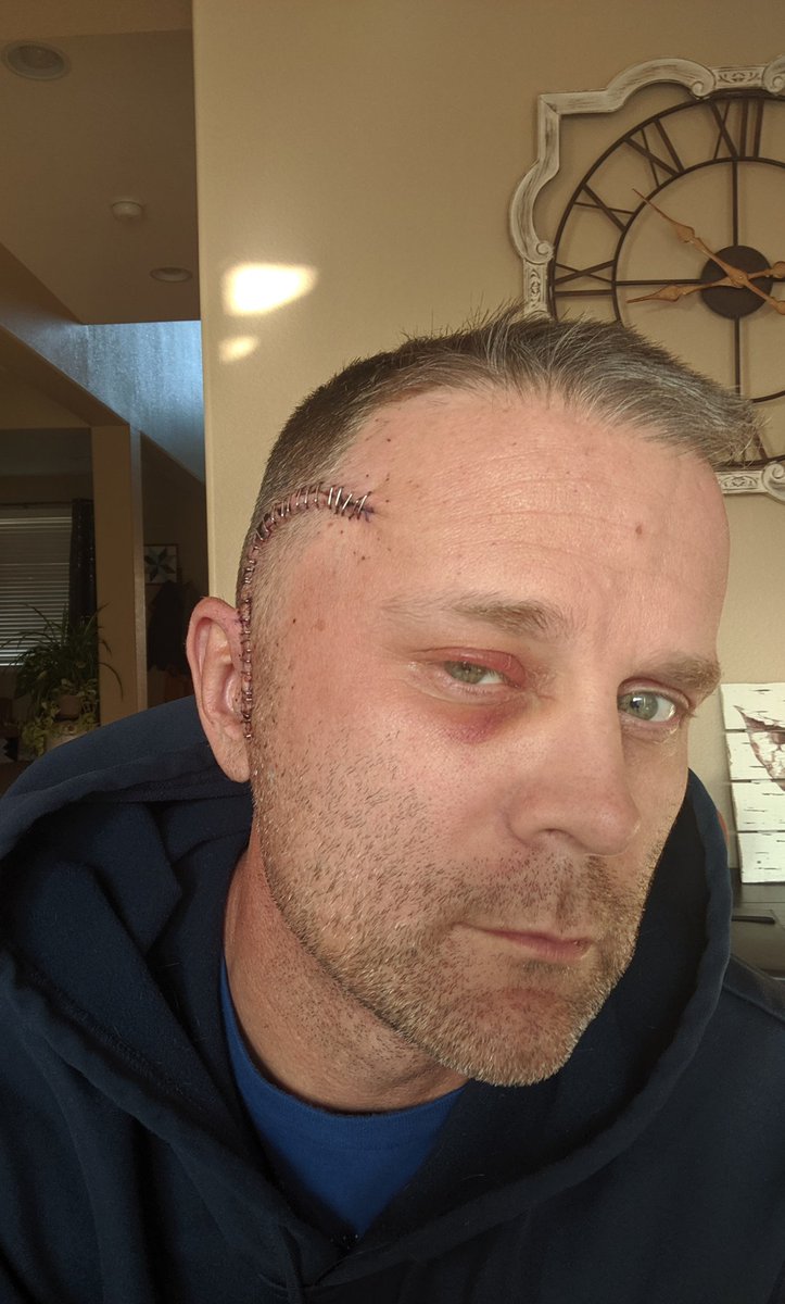gkilbourn31's tweet photo. #CancerSucks !!!
Circa 2019. 4 years ago and now going on year 18 of this damn fight!
#AlwaysGetBackUp
#NeverQuit https://t.co/8VxvRUuhKD