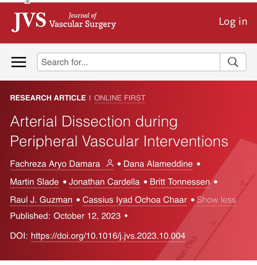 AryoDamara's tweet image. Arterial dissection (AD) during #PVI is underreported.

⚠️Our current analyses: 📈increase in the incidence of AD over the past years

@JVascSurg ,we identify factors associated with AD and it’s long-term significance: jvascsurg.org/article/S0741-…

@YaleVascular @Dr_Tonnessen @MdChaar