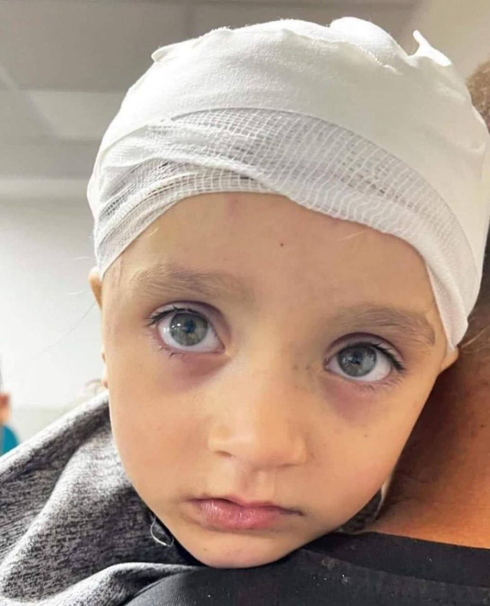 jacksonhinkle's tweet photo. 🇮🇱 Mariam is a little Palestinian girl who survived an Israeli BOMBING of her home.

🇮🇱 She suffered a skull fracture and a serious wound in her head due to the BOMBING. Her wound was sewed into 17 stitches without sedation due to the collapse of the healthcare system in Gaza. https://t.co/WQFtuSmjnu