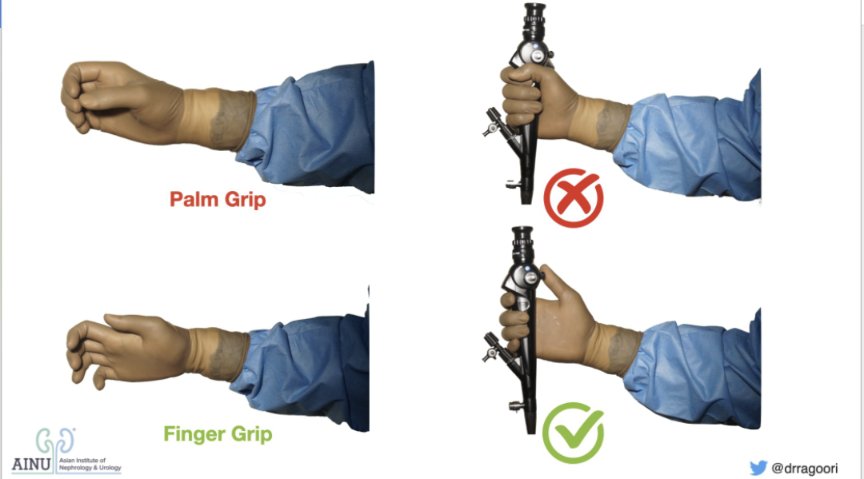 The FLUTE ๐ช (@thefluterirs) on Twitter photo Ergonomics in #RIRS: The Grip
โ Palm Grip - Locks wrist - Limited range of movts
โ
Finger Grip - Free wrist - Extended range of movts <a href="/ainuindia/">Asian Institute of Nephrology and Urology</a> <a href="/AmerUrological/">Amer. Urol. Assn.</a> <a href="/Uroweb/">European Association of Urology (EAU)</a> <a href="/usioffice/">Urological Society of India ๐ฎ๐ณ</a> <a href="/SIU_urology/">SIU-Urology</a> <a href="/YouthUSI/">YOUsi</a> <a href="/eau_yuo/">EAU Young Urologists</a> <a href="/Emiratesurology/">EUS</a> <a href="/CAU_URO/">Confederaciรณn Americana de Urologรญa (CAU)</a> <a href="/arab_asu/">Arab School Of Urology (ASU)</a> Watch out for more ! ๐ Ergonomics in #RIRS: The Grip
โ Palm Grip - Locks wrist - Limited range of movts
โ
Finger Grip - Free wrist - Extended range of movts <a href="/ainuindia/">Asian Institute of Nephrology and Urology</a> <a href="/AmerUrological/">Amer. Urol. Assn.</a> <a href="/Uroweb/">European Association of Urology (EAU)</a> <a href="/usioffice/">Urological Society of India ๐ฎ๐ณ</a> <a href="/SIU_urology/">SIU-Urology</a> <a href="/YouthUSI/">YOUsi</a> <a href="/eau_yuo/">EAU Young Urologists</a> <a href="/Emiratesurology/">EUS</a> <a href="/CAU_URO/">Confederaciรณn Americana de Urologรญa (CAU)</a> <a href="/arab_asu/">Arab School Of Urology (ASU)</a> Watch out for more ! ๐