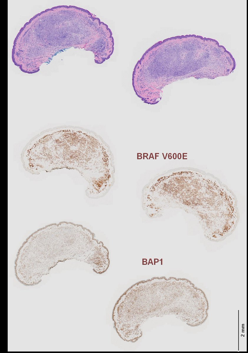 BAP1-inactivated melanocytoma. #dermpath #pathology #IHCpath