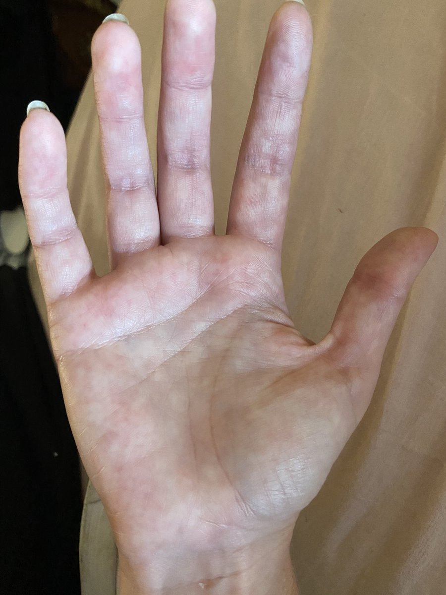 LCD_Dub's tweet photo. The pain in my hands and feet is unbearable this week. Soles of feet completely discoloured and having to โpopโ toes back into right place. WTF is this ๐
#LongCovid #notinmyhead https://t.co/6HpDw9DC1S