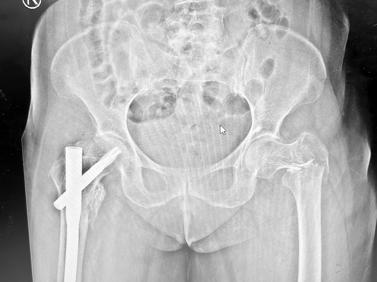 Bipin Theruvil FRCS (T&O),FRCS (Ed&Glasg),MS AIIMS tweet media