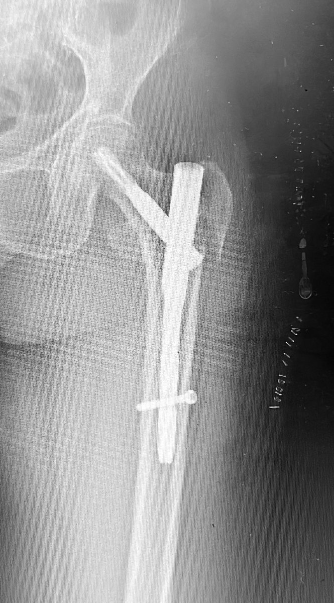 Bipin Theruvil FRCS (T&O),FRCS (Ed&Glasg),MS AIIMS tweet media