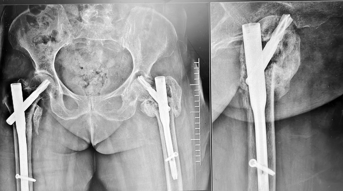 Bipin Theruvil FRCS (T&O),FRCS (Ed&Glasg),MS AIIMS tweet media