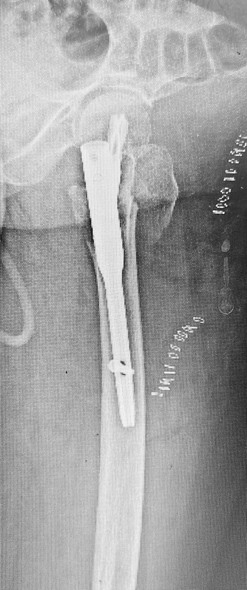 Bipin Theruvil FRCS (T&O),FRCS (Ed&Glasg),MS AIIMS tweet media