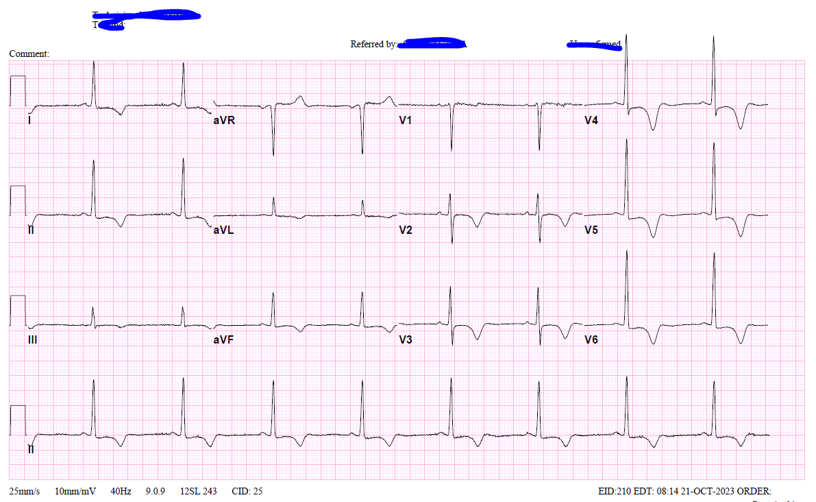 IhabFathiSulima's tweet photo. 70 Years old lady with Vague symptoms.
#ECG repeatedly the same Abnormalities.
#CT_Brain Normal.
Two sets of Troponin Negative.
#D_Dimer is Negative.
#ECHO LV function 55%. Apex is #Hypertrophied.
Diagnosis ?
What are the list of Differential for ECG. https://t.co/pBSf0cvl7N