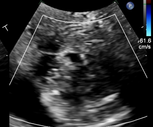 IhabFathiSulima's tweet photo. 70 Years old lady with Vague symptoms.
#ECG repeatedly the same Abnormalities.
#CT_Brain Normal.
Two sets of Troponin Negative.
#D_Dimer is Negative.
#ECHO LV function 55%. Apex is #Hypertrophied.
Diagnosis ?
What are the list of Differential for ECG. https://t.co/pBSf0cvl7N