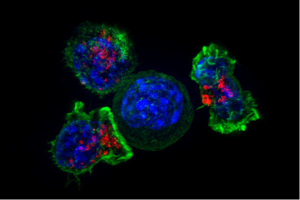 BiogenBR's tweet photo. ESTUDO MUNDIAL DESCOBRE QUE AS CÉLULAS IMUNOLÓGICAS SÃO CRUCIAIS PARA IMPEDIR O CÂNCER DE INTESTINO

DOI: 10.1126/sciimmunol.adf2163
Credibilidade: 999
#CélulasT

Pela primeira vez na medicina, os cientistas impediram o crescimento de cancros do intestino em ratos, aproveitando as células imunitárias do intestino grosso.

Um dos novos tratamentos contra o câncer mais interessantes é a imunoterapia, que funciona treinando o sistema imunológico do corpo para identificar e destruir as células cancerígenas.

No entanto, a maioria das imunoterapias atuais beneficia apenas uma pequena minoria de pacientes com cancro do intestino – menos de 10 por cento.

“Descobrimos que um importante grupo de células imunitárias no intestino grosso – as células T gama delta – são cruciais para prevenir o cancro do intestino”, diz a imunologista Lisa Mielke, do Instituto de Investigação do Cancro Olivia Newton-John da Universidade La Trobe, na Austrália.

Cerca de 1 em cada 10 casos de câncer é câncer de intestino. Segunda maior causa de morte relacionada ao câncer em todo o mundo, a falta de sintomas no início da progressão da doença significa que muitas vezes ela é diagnosticada tarde demais para ser tratada.

“Nossa pesquisa inédita no mundo abre um novo roteiro para o desenvolvimento de imunoterapias combinadas direcionadas para tratar de forma mais eficaz pacientes com câncer de intestino”, diz Marina Yakou, uma das principais autoras do estudo, estudante de doutorado no Olivia Newton-John Cancer Research Institute.

Yakou, Mielke e uma equipe de pesquisadores da Austrália e dos EUA analisaram amostras de tecidos de tumores de câncer de intestino, bem como amostras de pacientes sem câncer de intestino.

Eles notaram uma correlação entre células T gama delta e resultados clínicos favoráveis no câncer de intestino. Quando mais deste tipo de células imunológicas foram encontradas nos tumores de pacientes com câncer de intestino, eles tiveram maior probabilidade de sobreviver e de ter recuperações mais positivas.

“As células T gama delta atuam como nossos defensores da linha de frente no intestino”, diz Mielke. “O que torna estas células imunitárias extraordinárias é que elas patrulham e protegem constantemente as células epiteliais que revestem o intestino, agindo como guerreiras contra potenciais ameaças de cancro”.
...
https://t.co/90zvUpmR3j