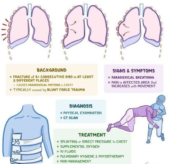 modernHealthMe's tweet photo. @BrownJHM #FlailChest for #MedTwitter https://t.co/neeG2cqwuX