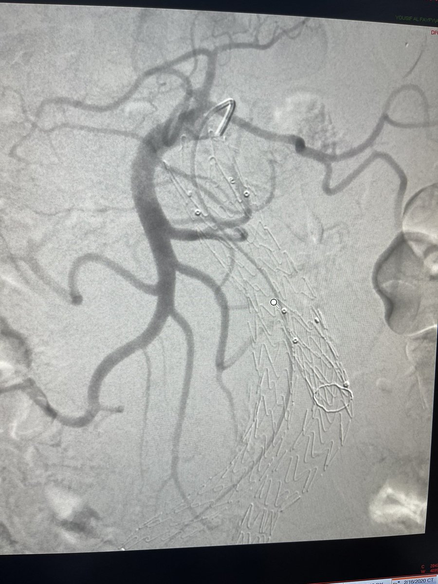 DrAlenazy's tweet image. Pt with #AAA with a type 2 endoleak s/p EVAR, fed by IMA on CTA.
#IRad can help   👌🏻Vey long way  
&amp;gt;&amp;gt;SMA-Middle Colic-Arc of Riolan-IMA-Sac. Then coils 
Done by KSMC IRad team 💪🏻💪🏻💪🏻
Dr mohammed ou7leous 
@Adeebmsg 
@Pombas99  thanks for support