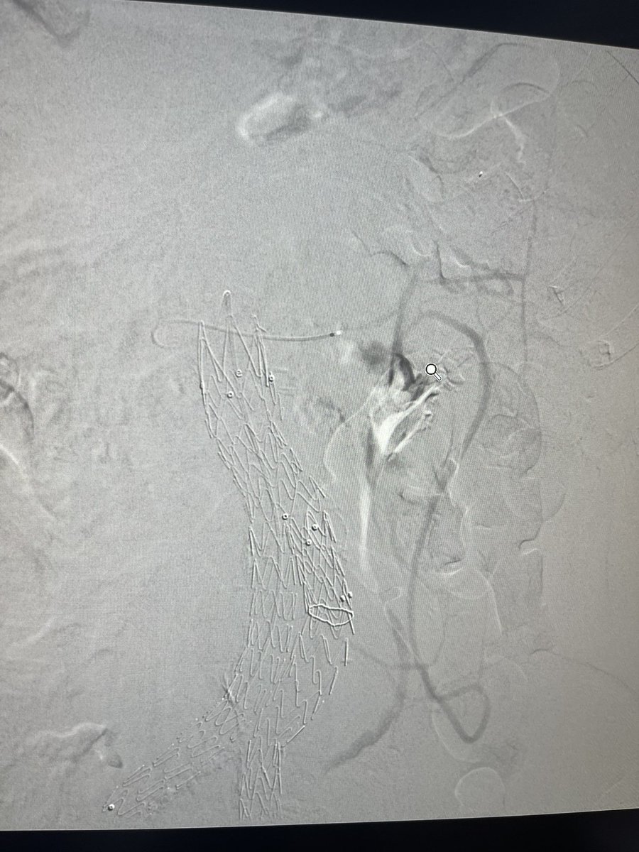 DrAlenazy's tweet image. Pt with #AAA with a type 2 endoleak s/p EVAR, fed by IMA on CTA.
#IRad can help   👌🏻Vey long way  
&amp;gt;&amp;gt;SMA-Middle Colic-Arc of Riolan-IMA-Sac. Then coils 
Done by KSMC IRad team 💪🏻💪🏻💪🏻
Dr mohammed ou7leous 
@Adeebmsg 
@Pombas99  thanks for support