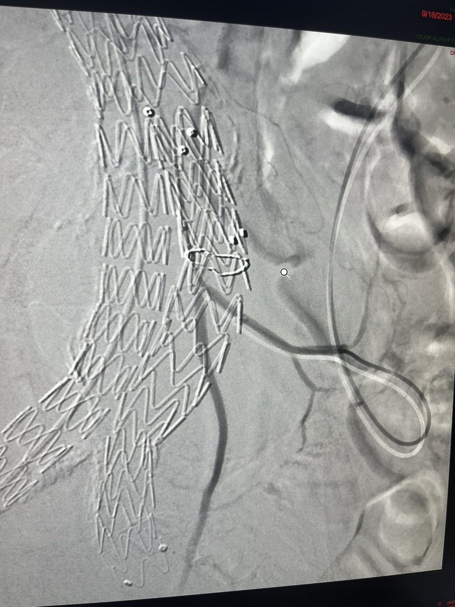 DrAlenazy's tweet image. Pt with #AAA with a type 2 endoleak s/p EVAR, fed by IMA on CTA.
#IRad can help   👌🏻Vey long way  
&amp;gt;&amp;gt;SMA-Middle Colic-Arc of Riolan-IMA-Sac. Then coils 
Done by KSMC IRad team 💪🏻💪🏻💪🏻
Dr mohammed ou7leous 
@Adeebmsg 
@Pombas99  thanks for support