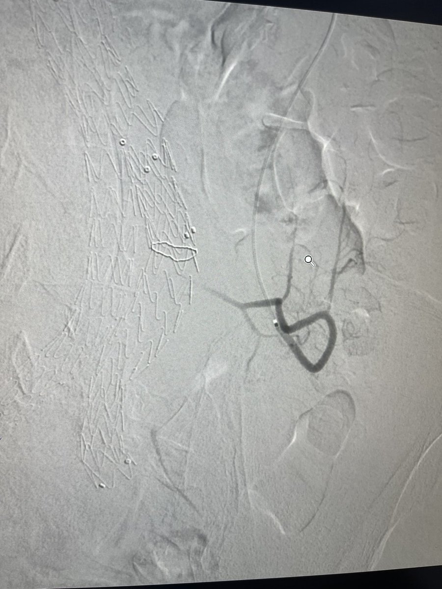 DrAlenazy's tweet image. Pt with #AAA with a type 2 endoleak s/p EVAR, fed by IMA on CTA.
#IRad can help   👌🏻Vey long way  
&amp;gt;&amp;gt;SMA-Middle Colic-Arc of Riolan-IMA-Sac. Then coils 
Done by KSMC IRad team 💪🏻💪🏻💪🏻
Dr mohammed ou7leous 
@Adeebmsg 
@Pombas99  thanks for support